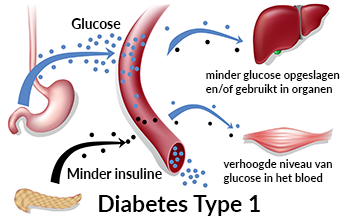Schematische weergave van diabetes type 1
